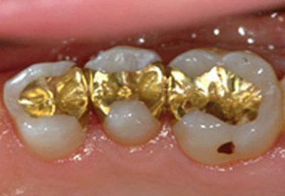Goldinlays